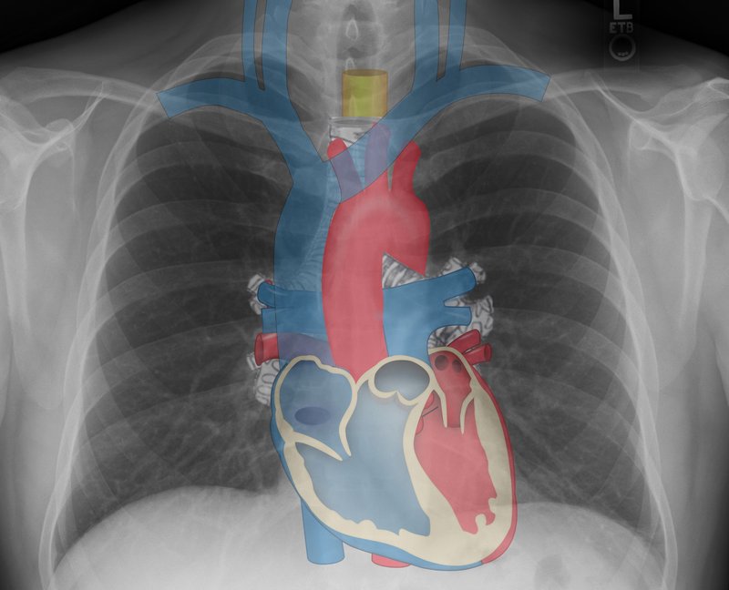 Annotated chest X-ray showing mediastinal structures including trachea, carina, aortic arch, and cardiac borders