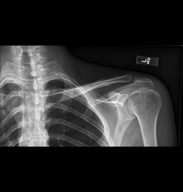 AP radiograph of the clavicle demonstrating the normal companion shadow parallel to the superior border of the clavicle