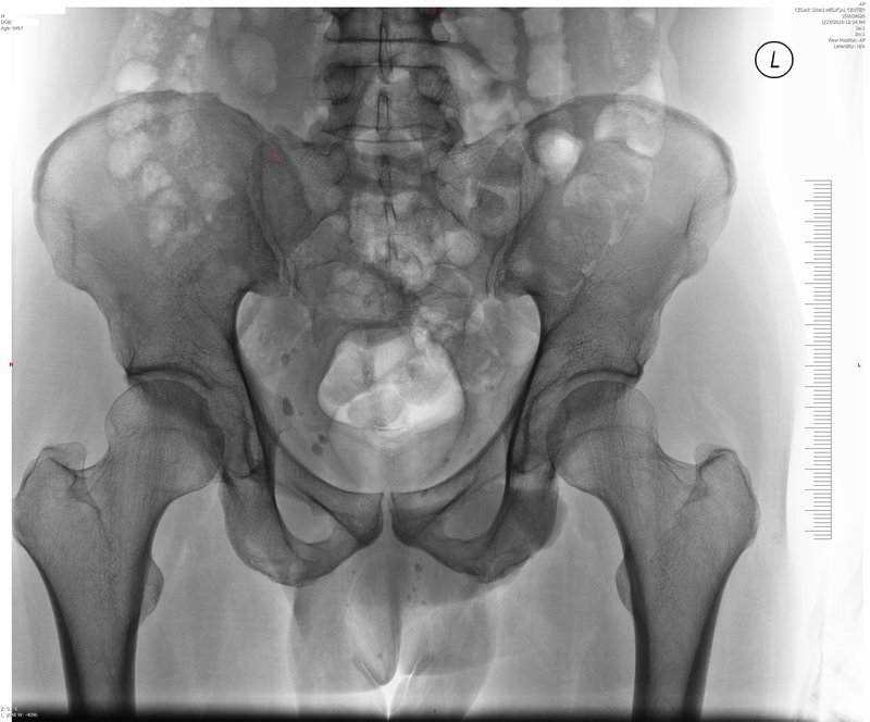 AP pelvis X-ray demonstrating normal hip joint anatomy including both femoral heads, femoral necks, and acetabula