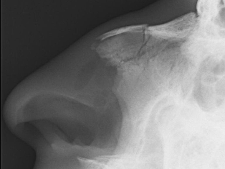 Lateral X-ray of the nasal bones showing a transverse fracture of the nasal bone with annotated findings