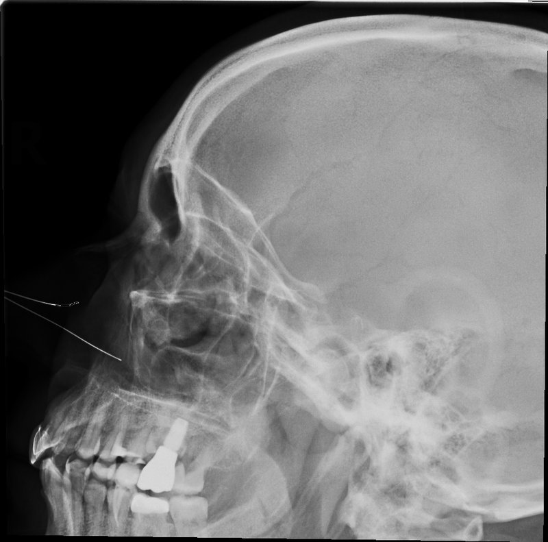 Lateral paranasal sinus X-ray radiograph showing all four sinus groups