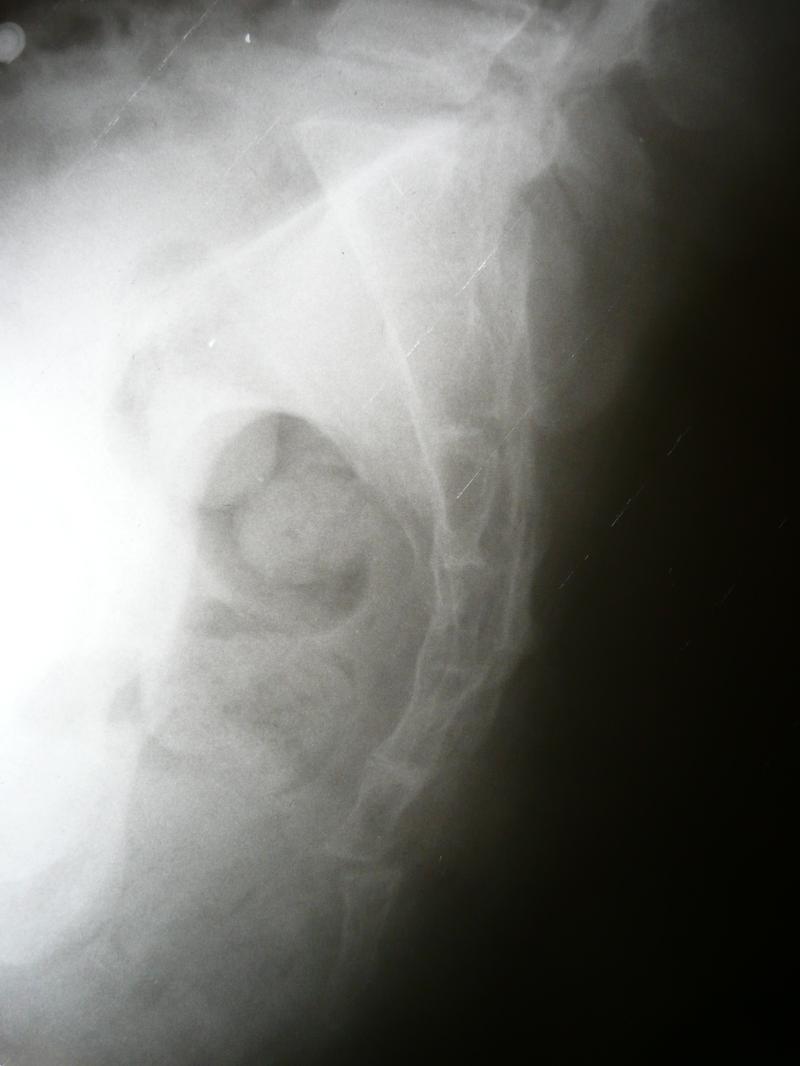 AP radiograph of the lower lumbar spine and sacrum demonstrating sacral anatomy