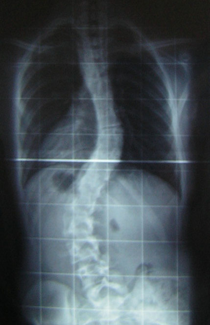 PA X-ray of adolescent idiopathic scoliosis showing thoracic curve of 30° and lumbar curve of 53° Cobb angle