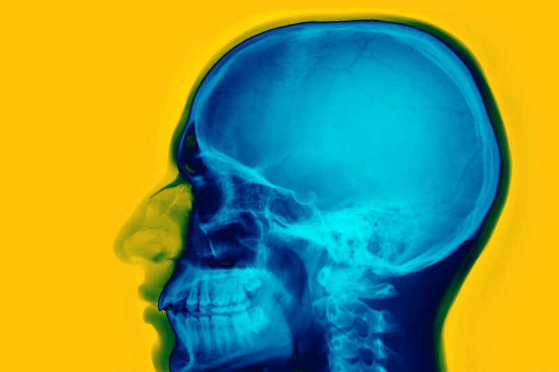 False-color lateral radiograph of the human skull showing the sella turcica and cranial anatomy