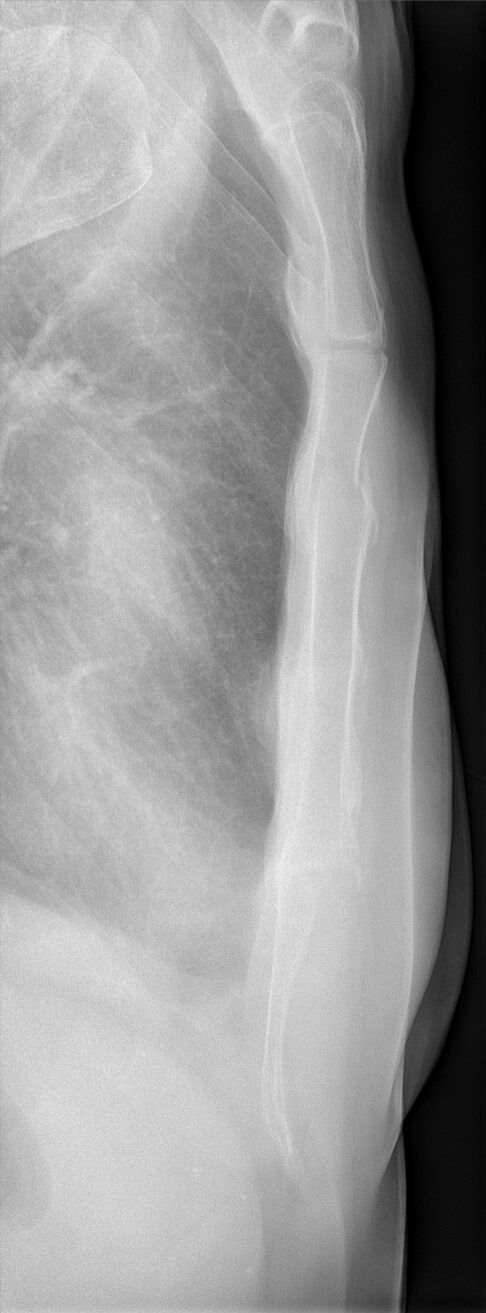 Lateral sternum radiograph showing the sternal body and an upper sternal body fracture