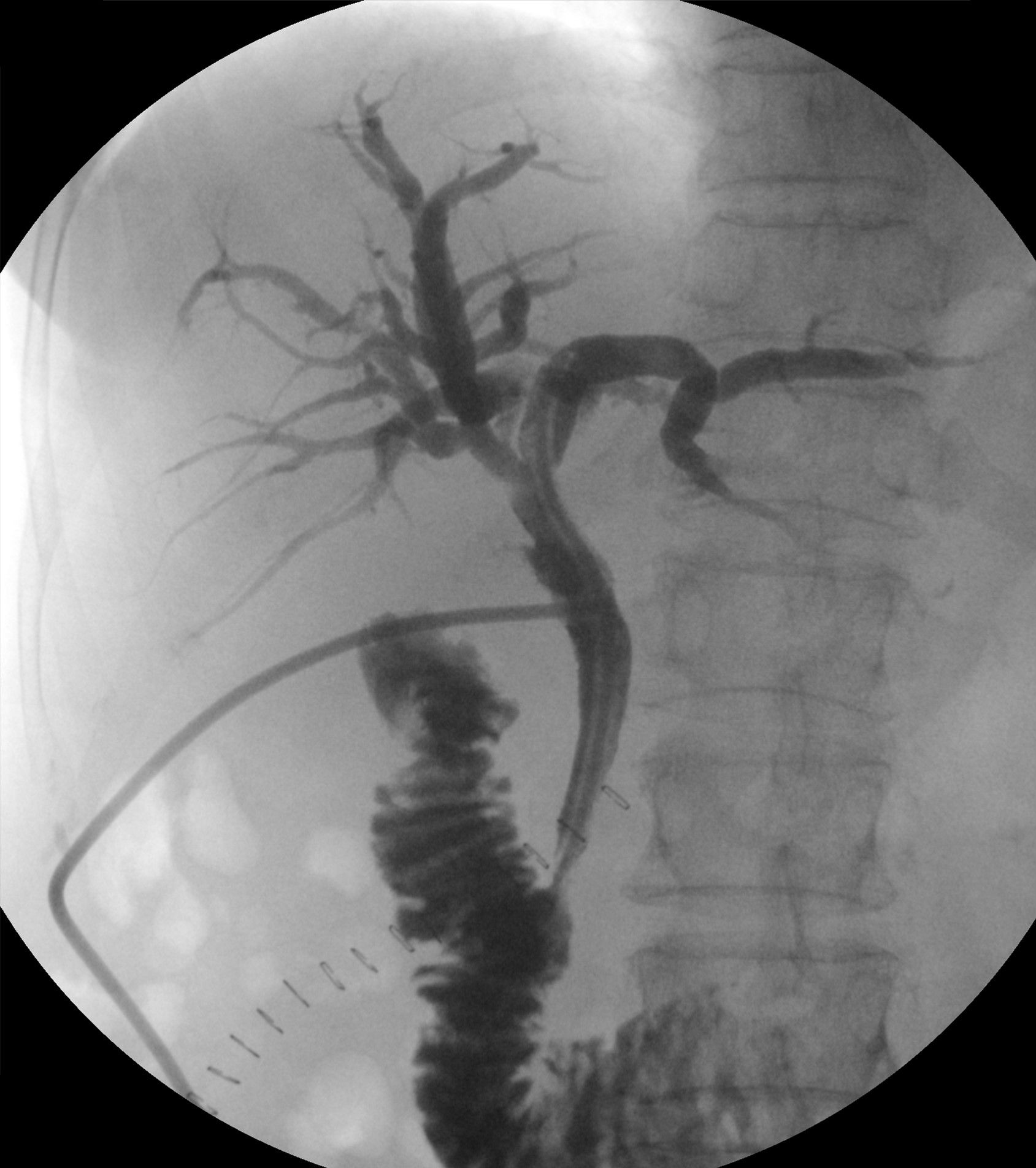 Fluoroscopic T-tube cholangiogram showing water-soluble iodinated contrast filling the bile duct through the drain tube