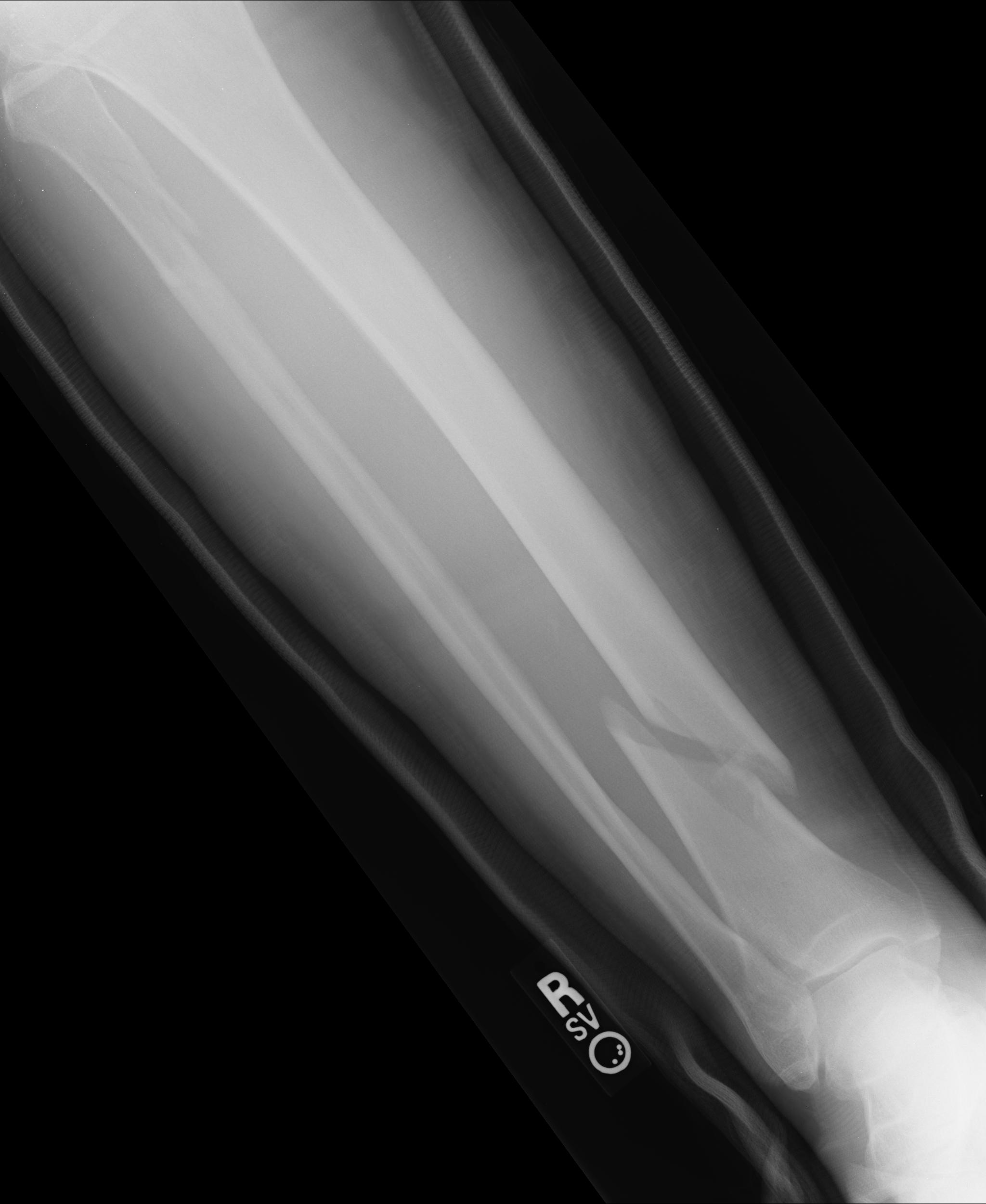 Annotated radiograph of the tibia and fibula showing the AP and lateral projections of the lower leg