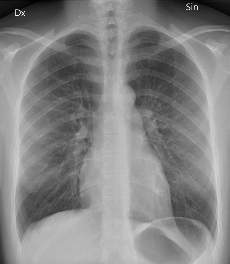 Normal posteroanterior (PA) chest radiograph showing the cardiac silhouette positioned close to the detector at the long 72-inch SID