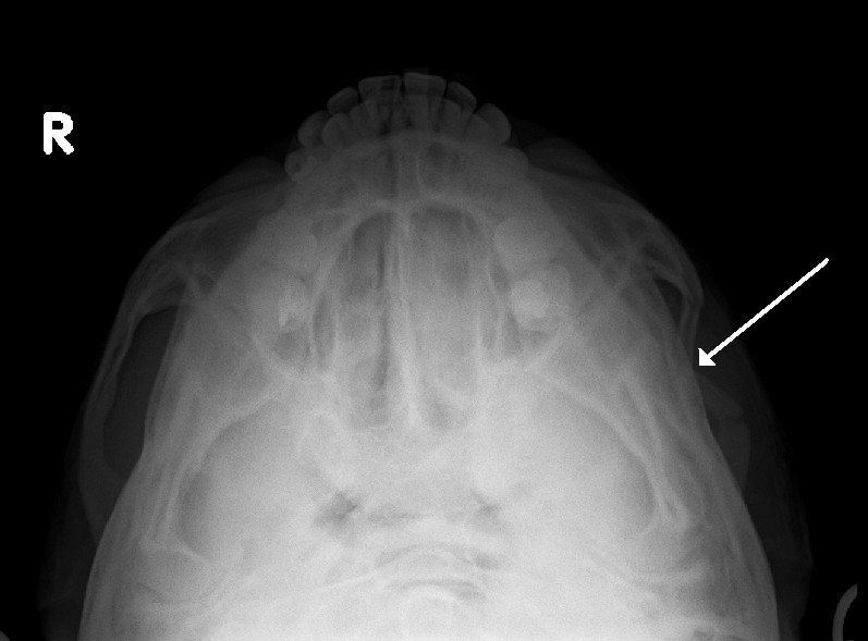 Radiograph demonstrating a fracture of the zygomatic arch marked by an arrow