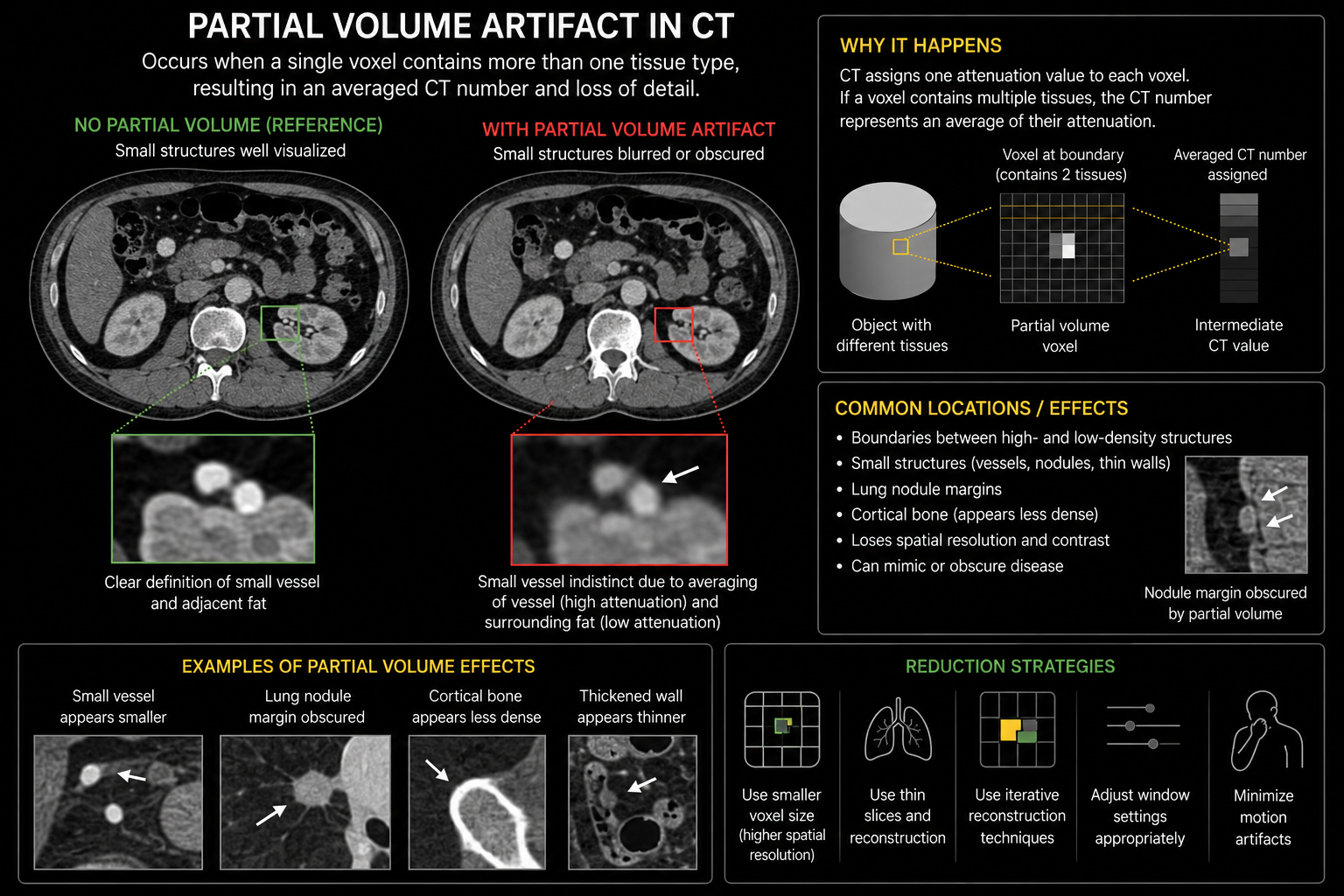 Partial volume CT artifact infographic