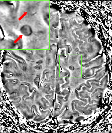 T2 FLAIR brain MRI showing multiple sclerosis plaques as hyperintense periventricular lesions