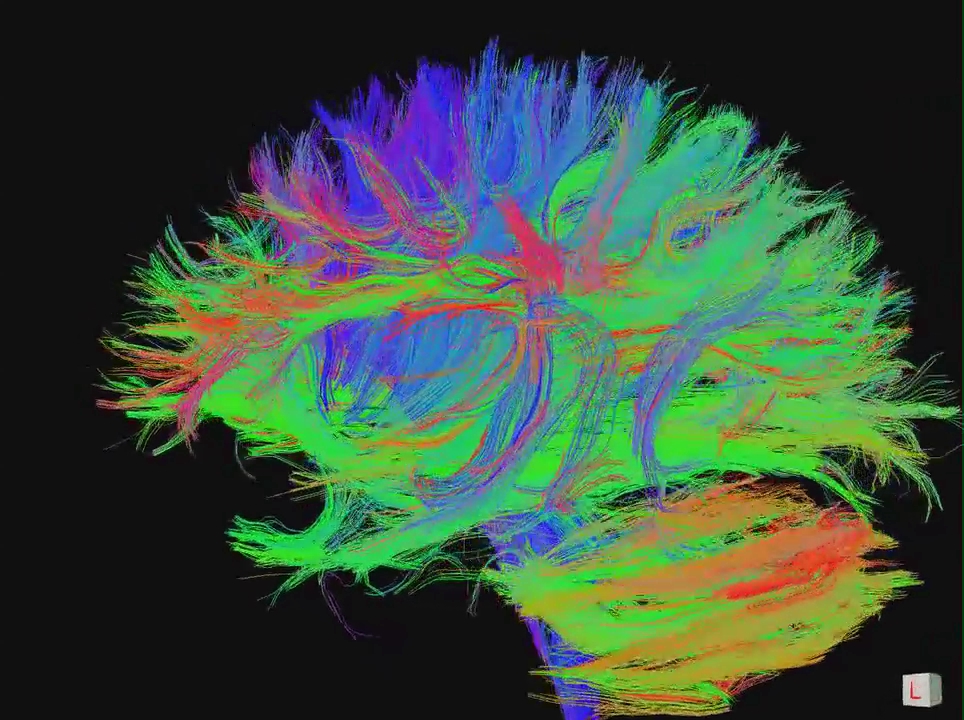 DTI tractography connectome showing white matter fiber tracts in the brain