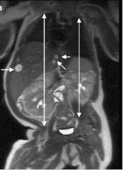 Coronal T2-HASTE MRI showing multiple hepatic hemangiomas as hyperintense liver lesions