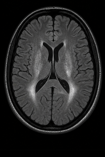 Generated axial FLAIR brain MRI scan with dark suppressed CSF