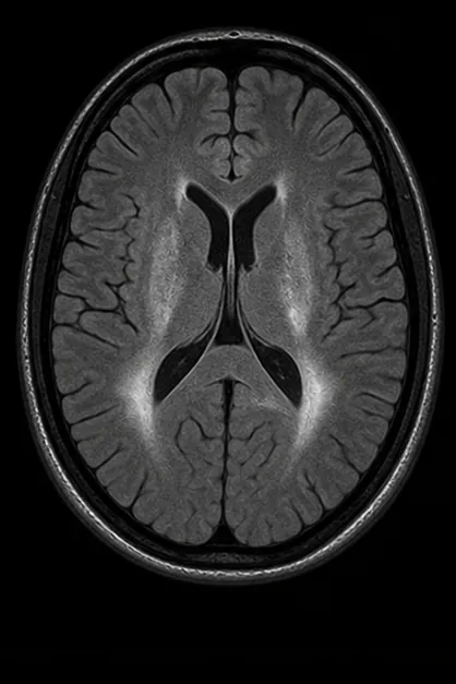 Generated axial FLAIR brain MRI scan with dark suppressed CSF