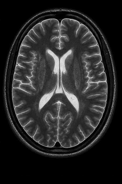 Generated axial STIR-style brain MRI scan with fat suppression and bright fluid