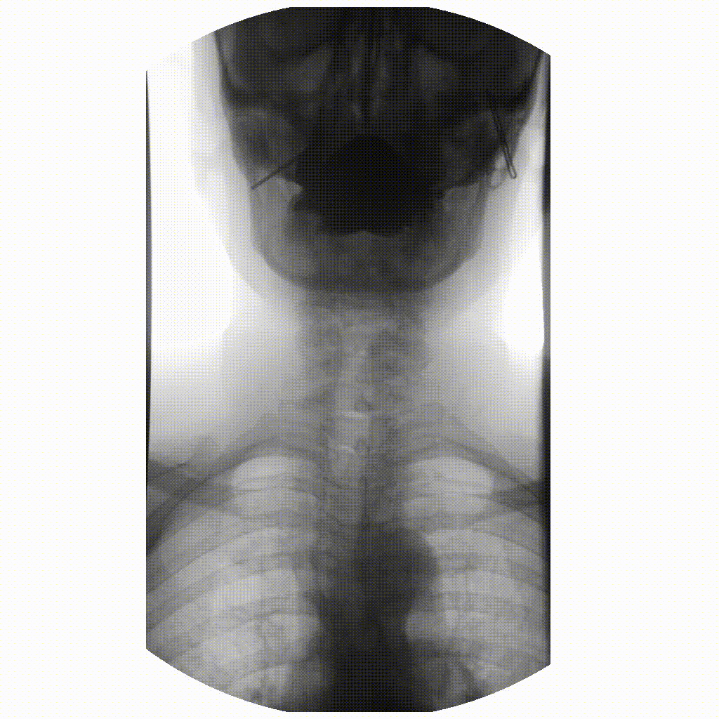 Fluoroscopy barium swallow study