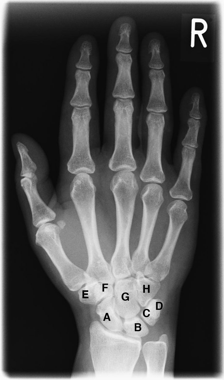 Hand X-ray showing bone structure