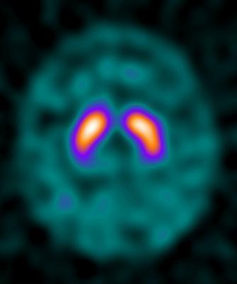 DaTSCAN SPECT image showing striatal radiotracer uptake in the brain