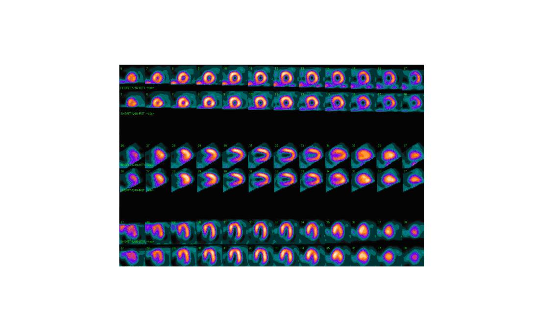 Nuclear medicine myocardial perfusion SPECT scan of the heart
