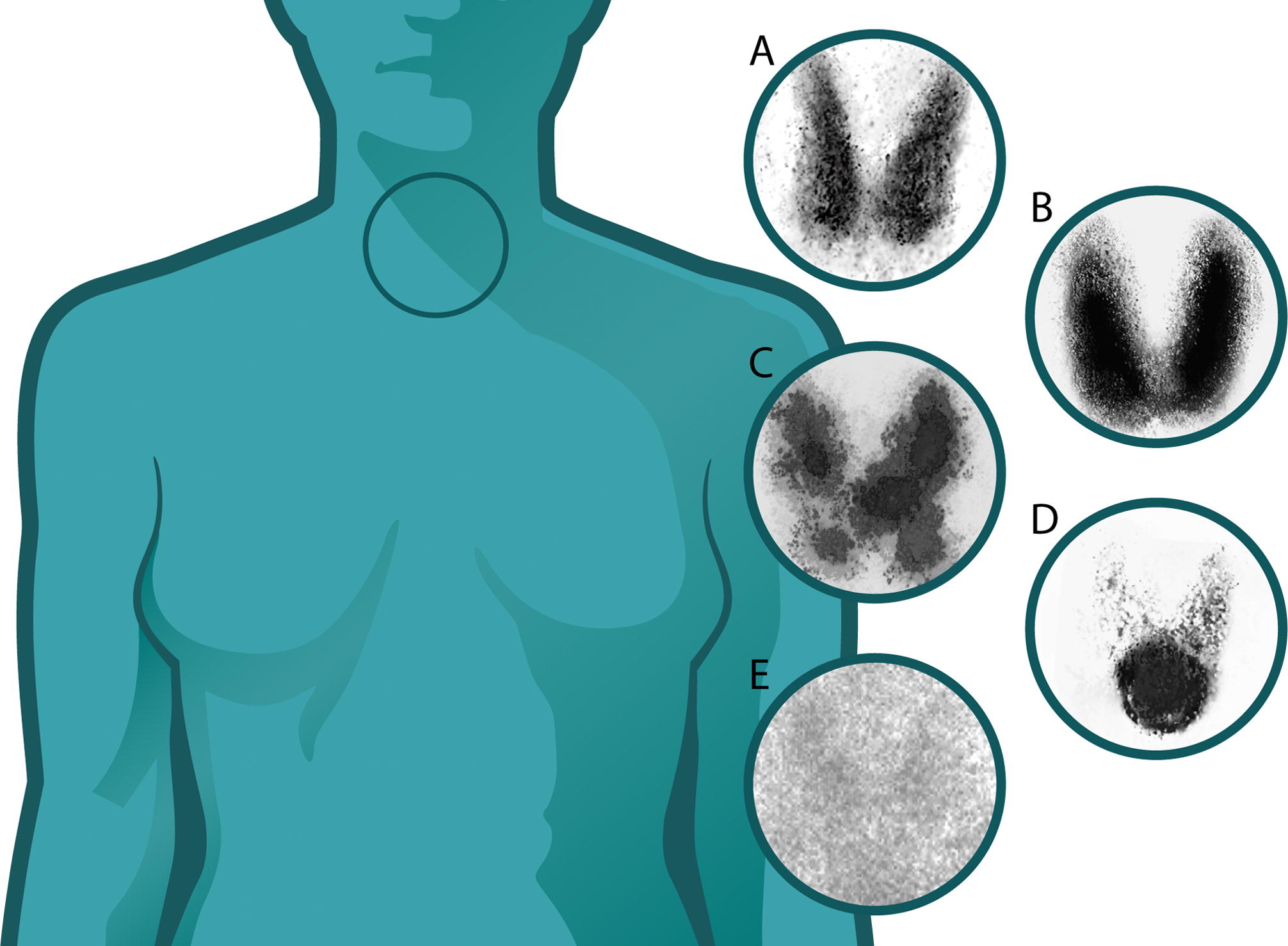 Thyroid scintigraphy comparison showing different thyroid uptake patterns