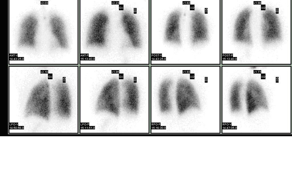 Nuclear medicine ventilation and perfusion lung scan