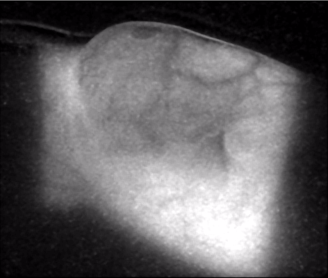 Cherenkov light image from a patient undergoing whole breast irradiation with a 6 MV radiotherapy beam.