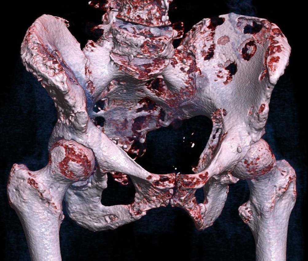 Three-dimensional CT rendering of hip bone metastases, a common target for palliative radiotherapy.