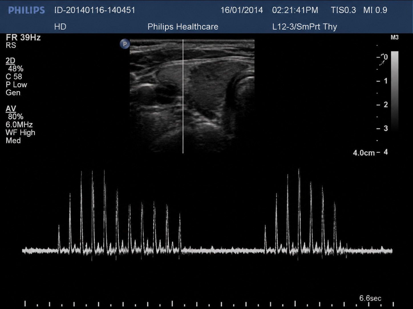 A-mode ultrasound monitor display with echo amplitude spikes beneath a grayscale thyroid scan.