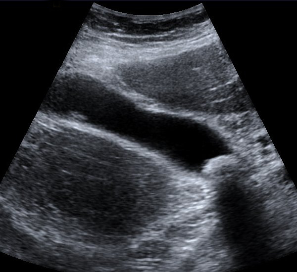 Abdominal ultrasound image showing gallstone evaluation