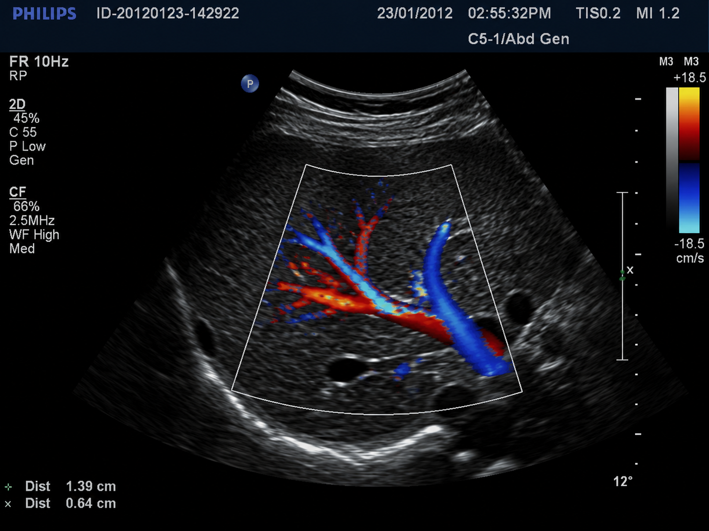 Color Doppler abdominal ultrasound display showing red and blue blood flow within the liver.