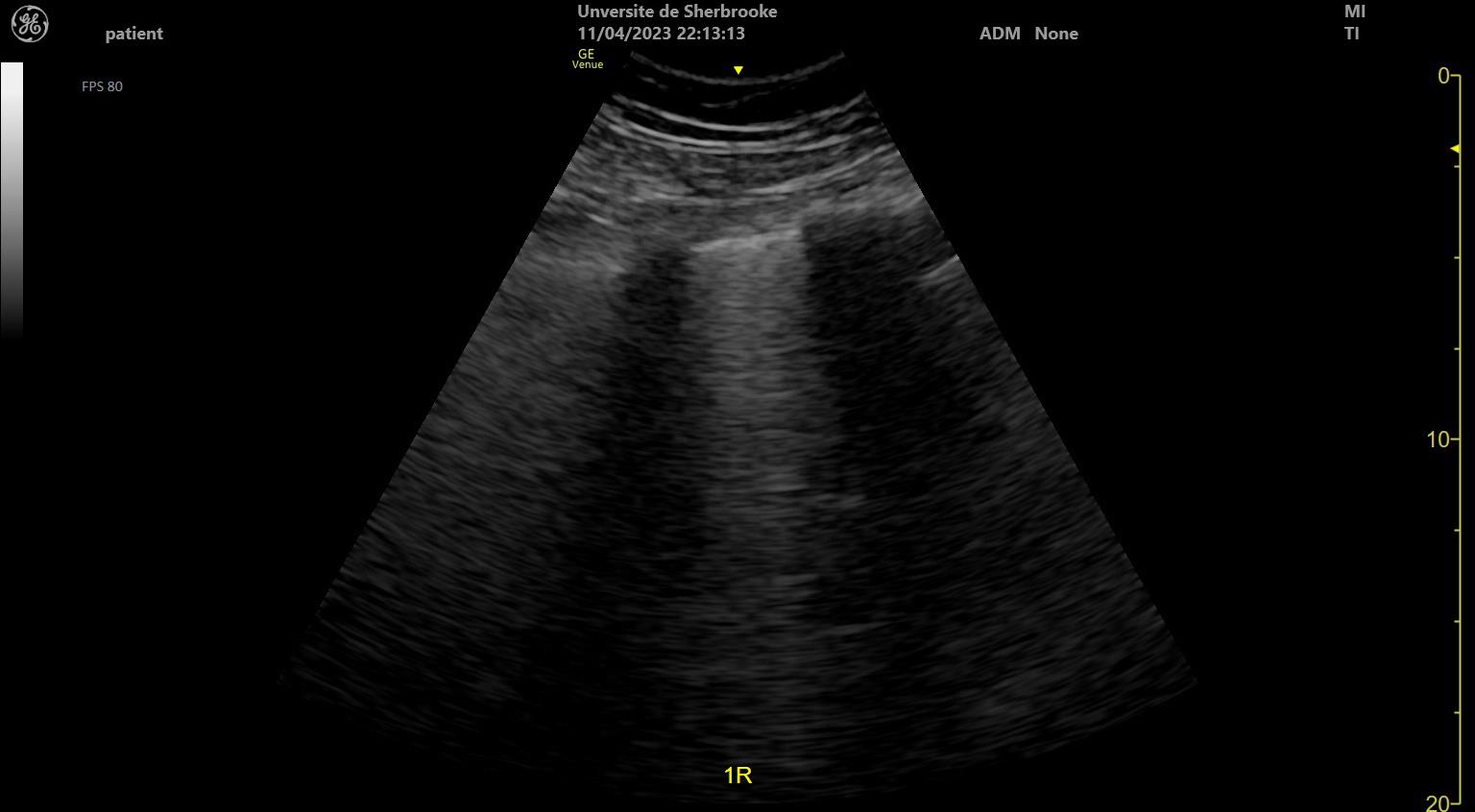 Point-of-care lung ultrasound image showing B-lines