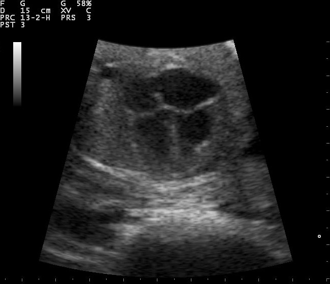 Obstetric ultrasound image of a fetus