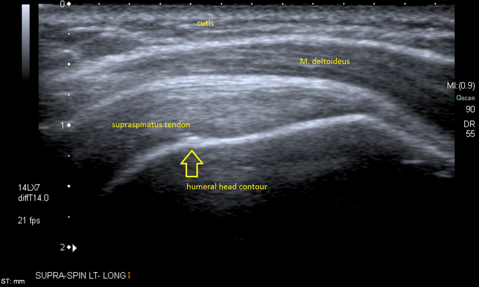 Musculoskeletal ultrasound image of the supraspinatus tendon