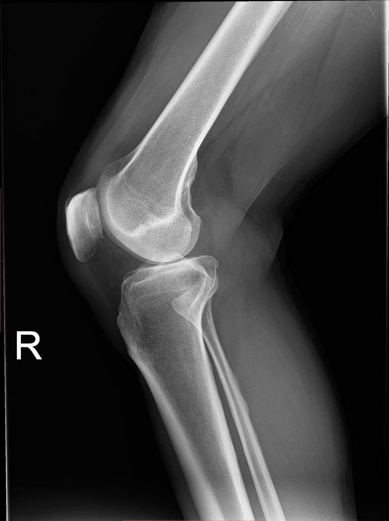 Plain film X-ray of a knee showing femur, tibia, and joint space